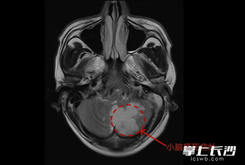 头部影像学检查提示，患者小脑大面积出现脑梗死病灶。 通讯员供图